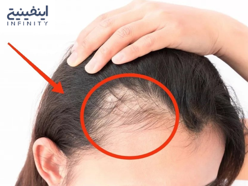علت ریزش مو