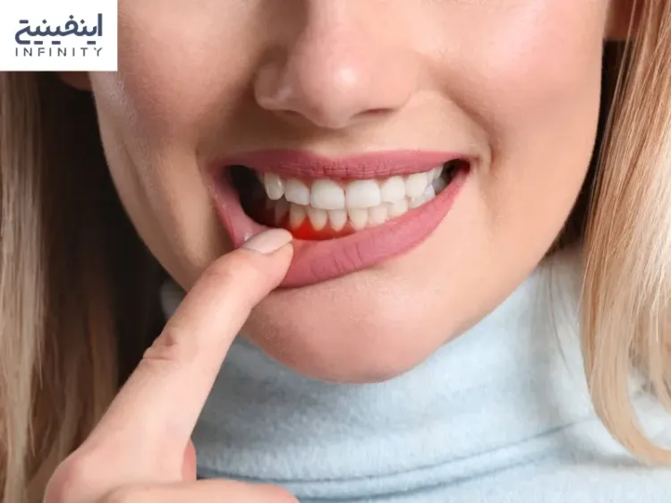علت و راه های درمان خونریزی لثه