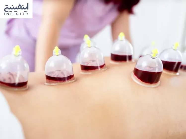 فواید و عوارض حجامت در علم پزشکی