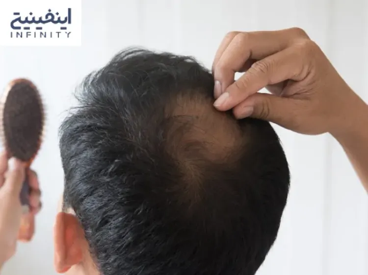 آیا درمان قطعی برای ریزش مو سکهای(آلوپسی آرهآتا) وجود دارد؟